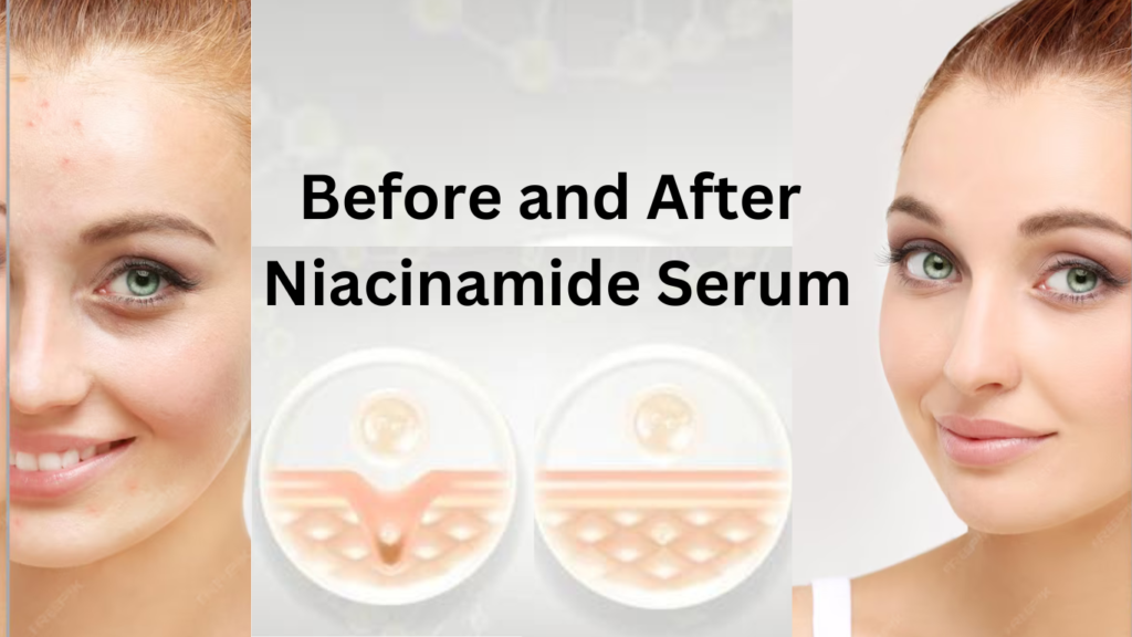 Before and after photos of a woman showing skin improvement from using niacinamide serum.