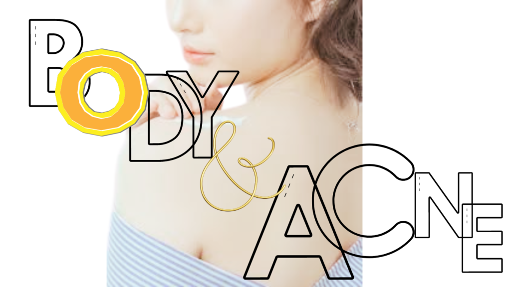 A beautiful girl with visible back acne, highlighting her struggle with body and back acne.
