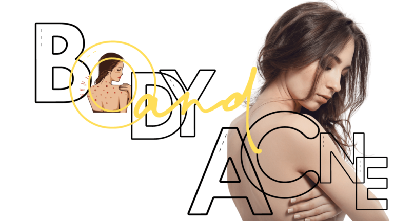 A beautiful girl with visible back acne, highlighting her struggle with body and back acne.