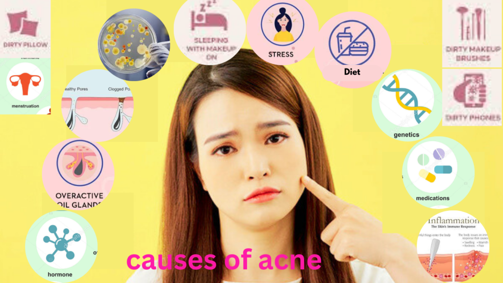 A girl with acne-prone skin surrounded by icons representing the causes of acne, including bacteria, excess oil, hormonal imbalance, and clogged pores.